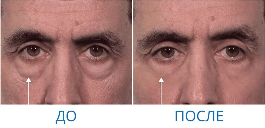 До и после: Анатолий П. 51 год. г. Иркутск