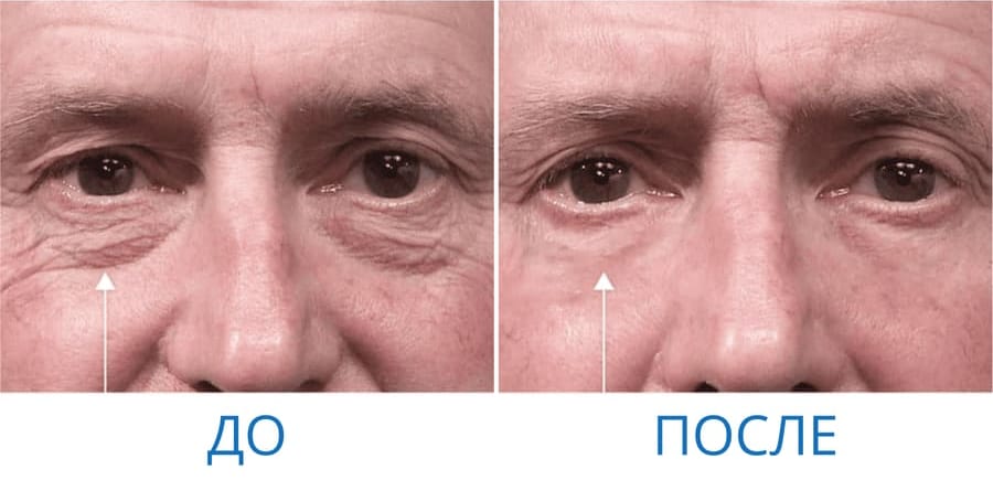 До и после: Александр М. 60 лет. г. Екатеринбург